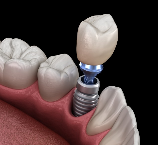 Animated smile during dental implant supported replacement tooth placement