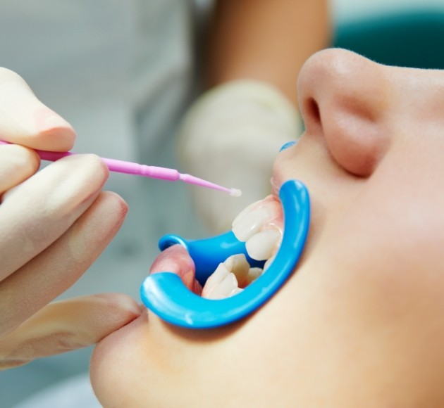 Patient receiving fluoride treatment