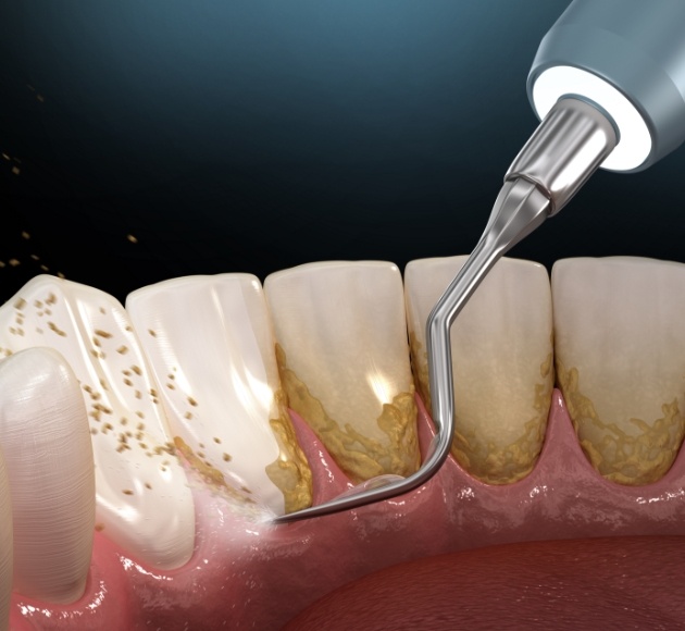 Animated smile during deep cleaning process