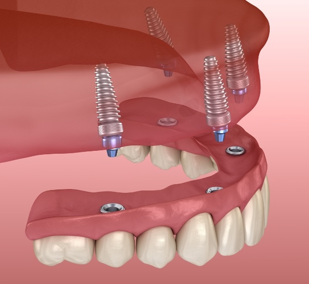 Animated smile during dental implant retained denture placement