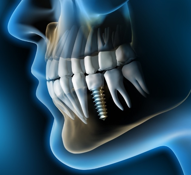 Animated facial profile with dental implant supported dental crown in place
