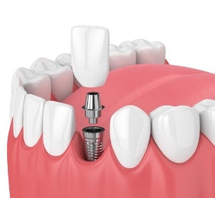 Animated smile during dental implant supported dental crown placement