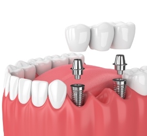 Animated smile during dental implant supported fixed bridge placement