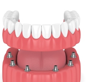 Animated smile during dental implant supported denture placement