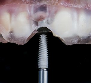Model smile demonstrating dental implant surgery
