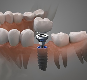 Animated smile during dental implant osseointegration and abutment placement process
