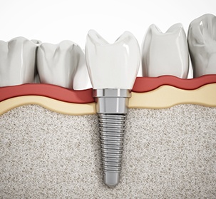 Animated smile during dental implant restoration
