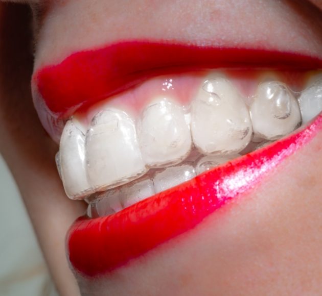 Closeup of smile with Invisalign clear braces in place