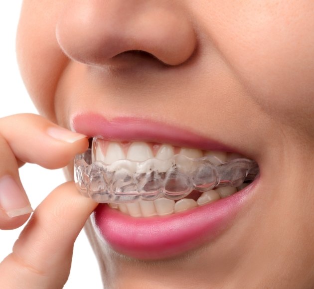 Closeup of patient placing an Invisalign tray