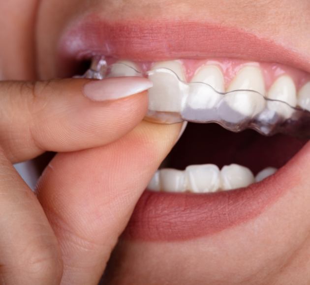 Closeup of patient placing an Invisalign tray