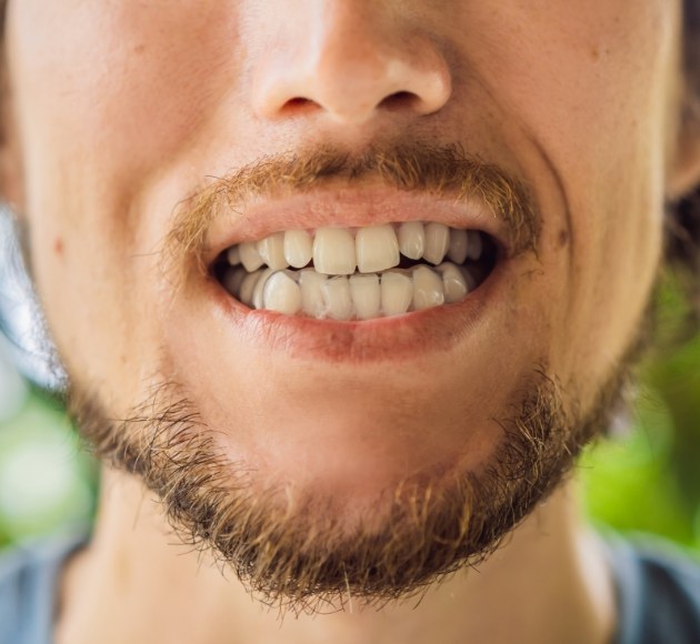 Closeup of smile with upper and lower Invisalign trays in place