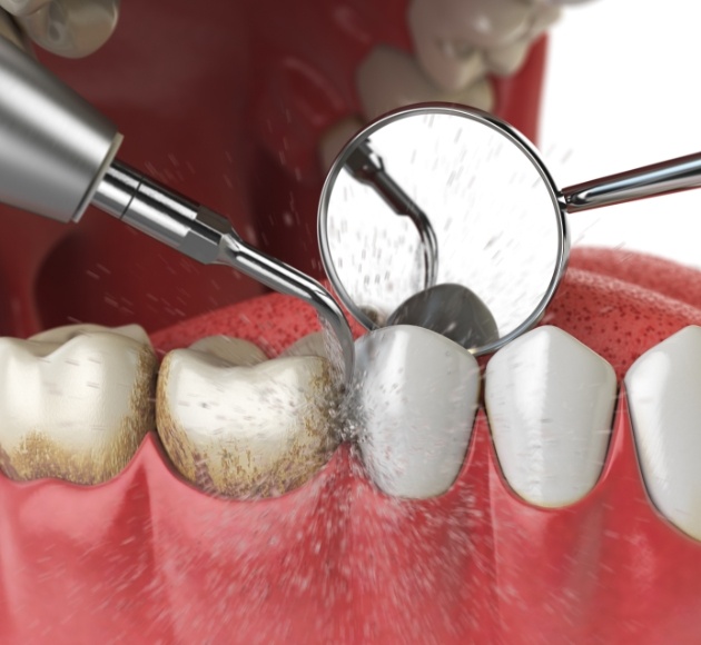 Animated smile during deep cleaning to remove plaque that leads to gum disease