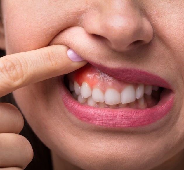 Closeup of smile with inflamed gums