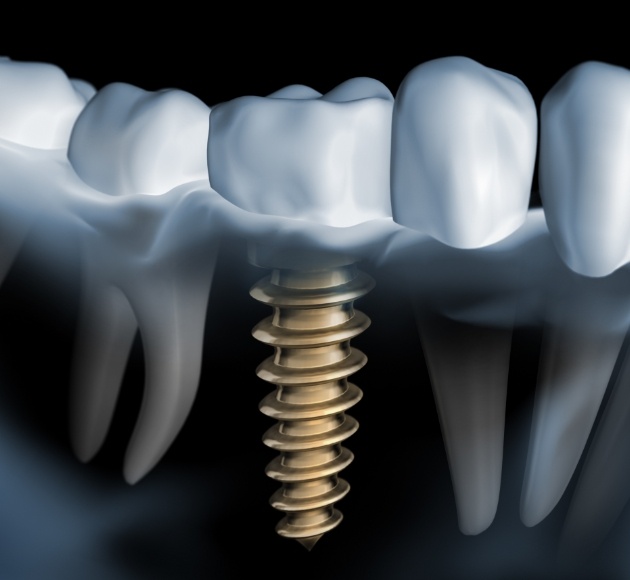 Animated smile during dental implant supported dental crown