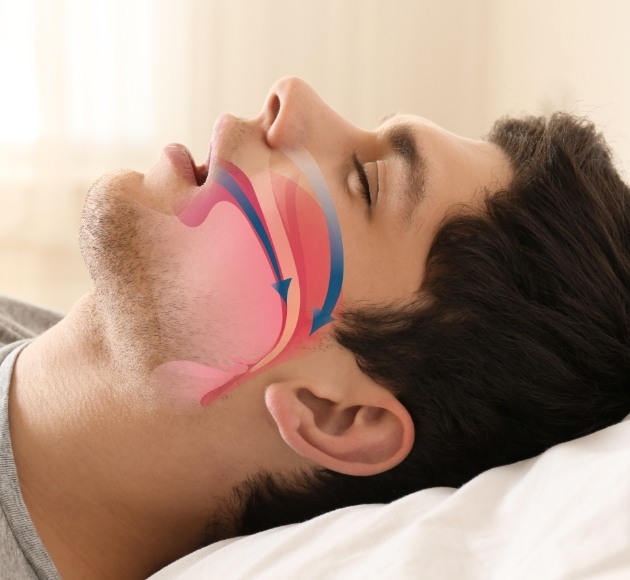 Man with animation demonstrating airway obstruction that causes sleep apnea