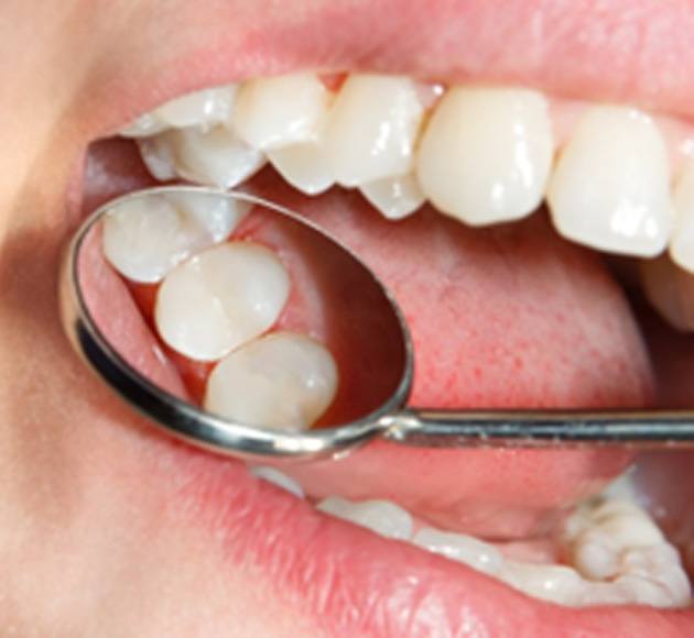 metal fillings vs tooth-colored fillings 