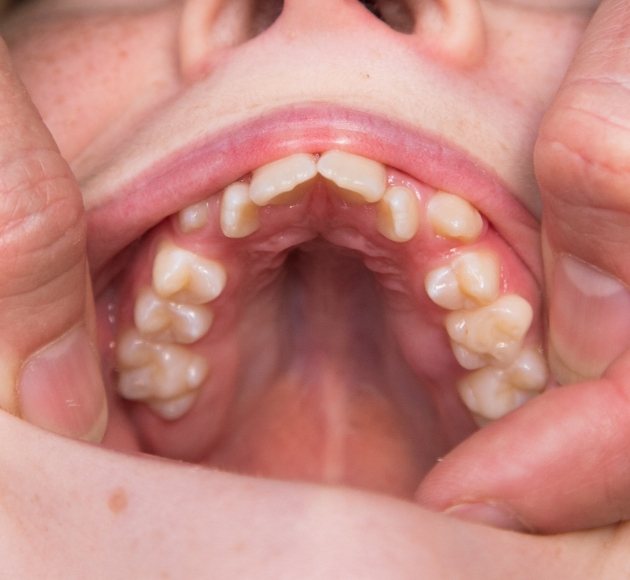Croked teeth caused by thumb sucking