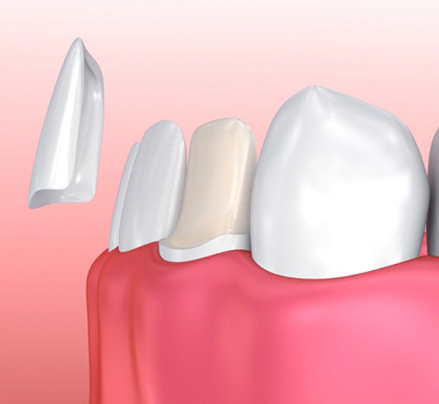 Model of veneer for lower tooth