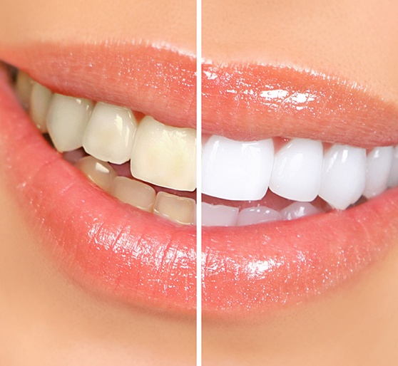 a before and after shot of teeth whitening