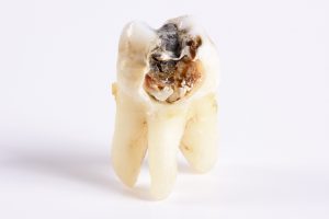 Root canal therapy in Natick removes infected pulp