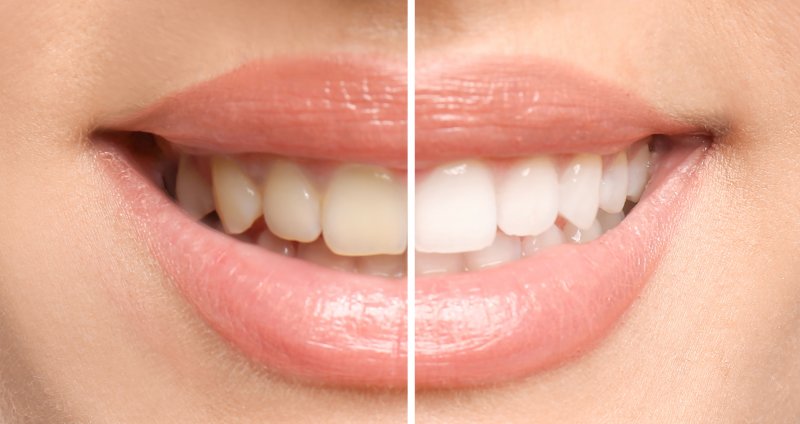 Teeth whitening before and after