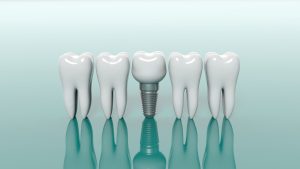 Model showing the basics of dental implants